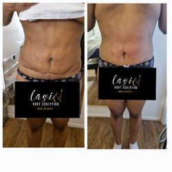 pre seroma fibrosis treatment and post seroma fibrosis treatment